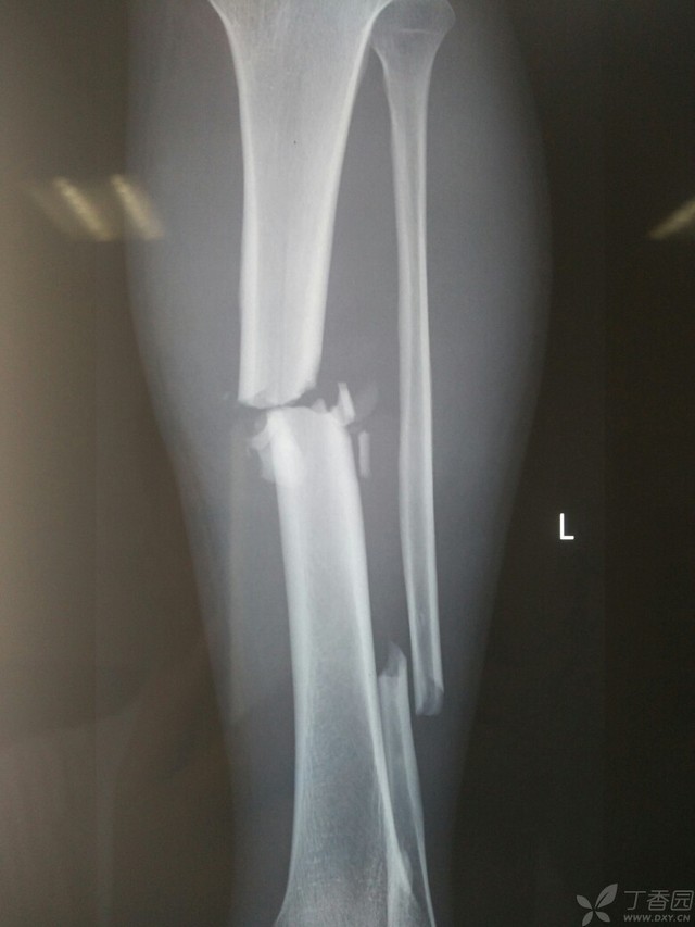 科技重塑脛腓骨骨折康復之旅，引領(lǐng)未來(lái)體驗新篇章