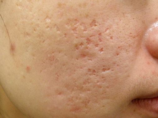 最新痘坑撫平神器，科技重塑肌膚之美，自信生活從此開(kāi)始