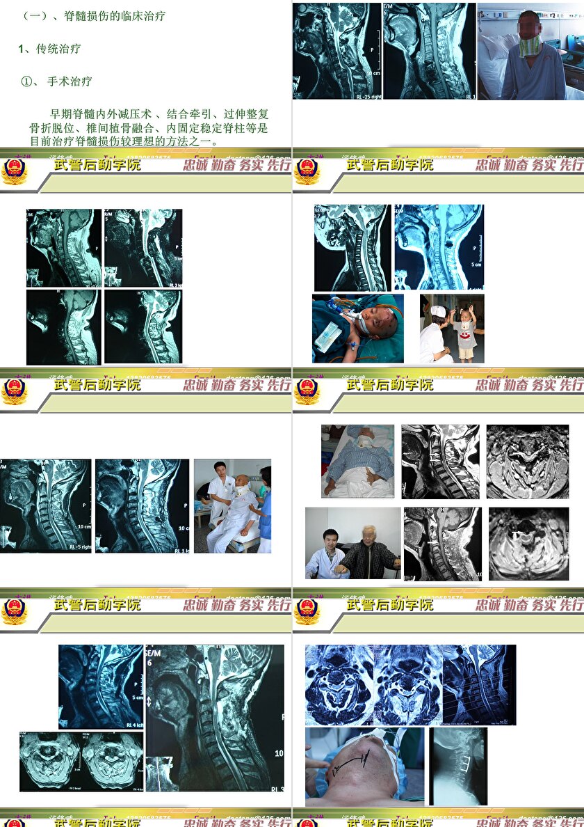 2023年脊髓損傷研究新進(jìn)展，里程碑式的突破與日常奇妙變化